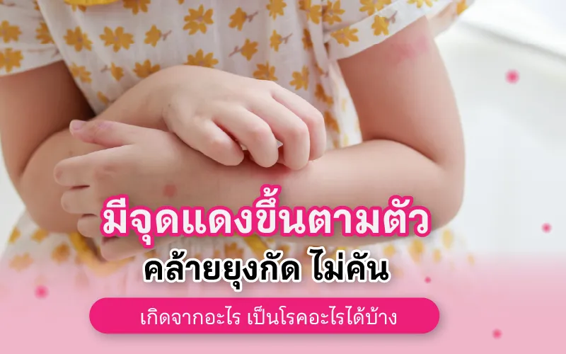 มีจุดแดงขึ้นตามตัว คล้ายยุงกัด ไม่คัน เกิดจากอะไร เป็นโรคอะไรได้บ้าง 02
